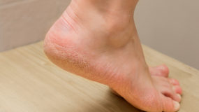 dry cracked feet and calluses