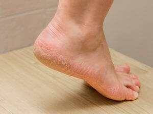 dry cracked feet