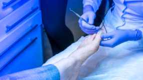 Ingrown toenail surgery