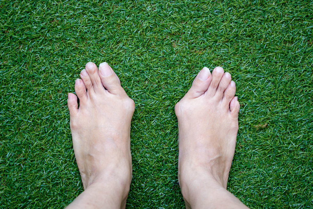 7 Exercises Great for Relieving Bunion Pain Elizabeth E. Auger, DPM