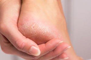 Foot Calluses : Your Questions Answered