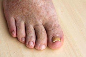 toenail with fungal infection