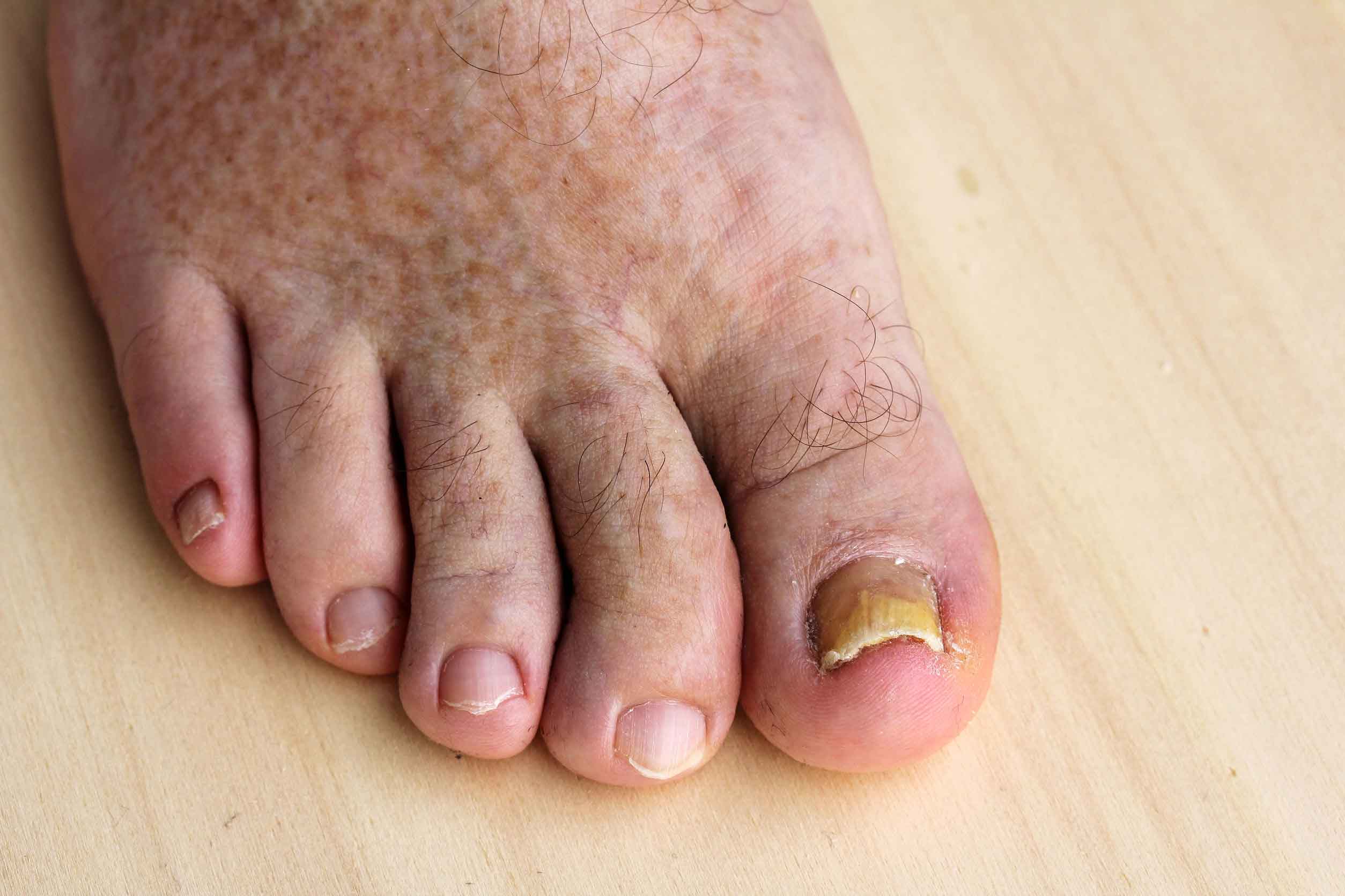Fungal Infections and Thickened Nails – Heal'nToes