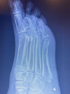 An x-ray image of a fractured 5th metatarsal.