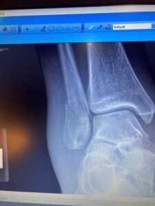 An x-ray image of a fractured ankle.