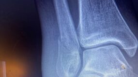 An x-ray image of a fractured ankle.