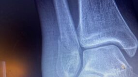 An x-ray image of a fractured ankle.