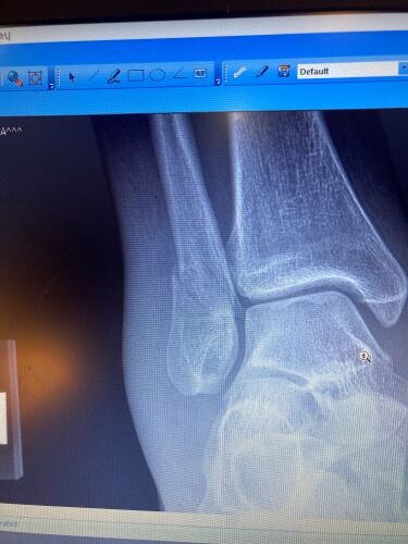 sprained ankle x ray