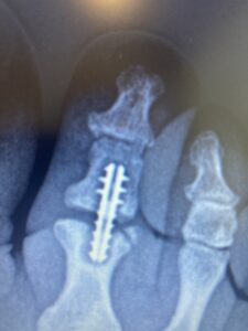 An x-ray of a surgically healed bone nonunion in the big toe.