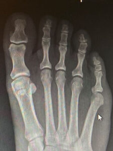An x-ray of a foot. 