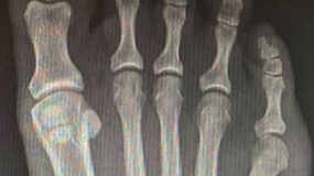 A x-ray of a foot with Tailor's Bunion.