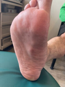 A closeup of plantar fibroma, or fibroma of the foot.