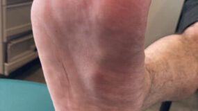 A closeup of plantar fibroma, or fibroma of the foot.