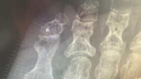 An x-ray of a patient with osteomyelitis, or bone infection.