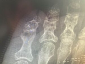 An x-ray of a patient with osteomyelitis, or bone infection. 