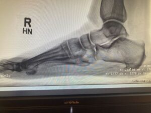 Plantar heel spur show in x-ray