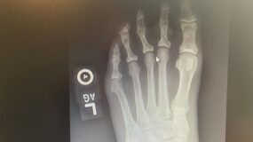 x-ray of toe with separation on left foot