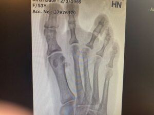 x-ray of toe with seperation