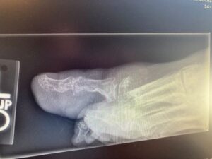 An x-ray of a toe with gout.