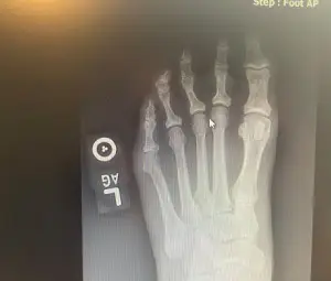 x-ray of toe with separation on left foot