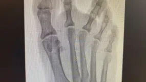 x-ray of toe with seperation