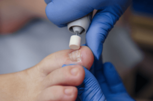 A closeup of a podiatrist treating a patient whose ingrown nail led to stunted nail growth.