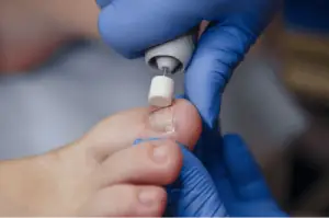 A closeup of a podiatrist treating a patient whose ingrown nail led to stunted nail growth.