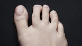 toe with sesamoiditis symptoms