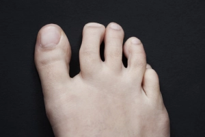 toe with sesamoiditis symptoms