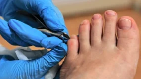 Podiatrist trimming a patient’s toenail to treat an ingrown toenail.